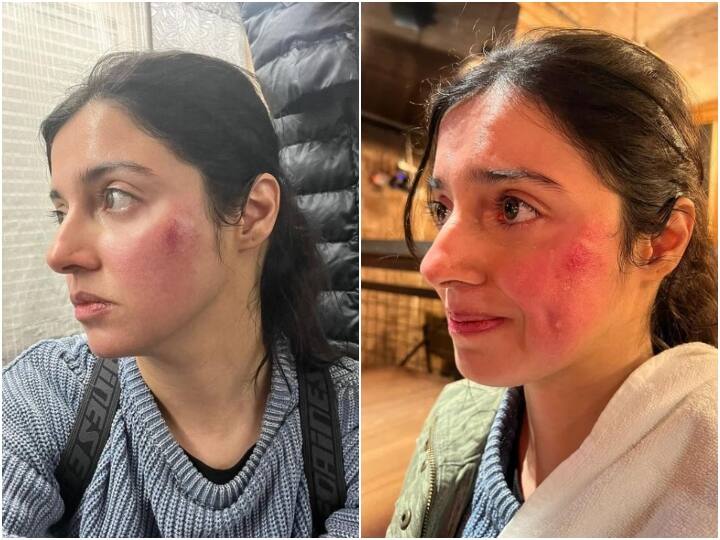 Divya Khosla Kumar got injured during the shooting of an action sequence see her pictures Divya Khosla Kumar को शूटिंग के दौरान लगी चोट, एक्ट्रेस ने तस्वीरें शेयर कर लिखा- 'शो मस्ट गो ऑन'