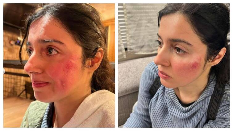 Divya Khosla Kuma injured during shooting actress shares pic Divya Khosla Kumarને શૂટિંગ દરમિયાન થઈ ઈજા, અભિનેત્રીએ તસવીરો શેર કરી લખ્યું- 'શો મસ્ટ ગો ઓન'