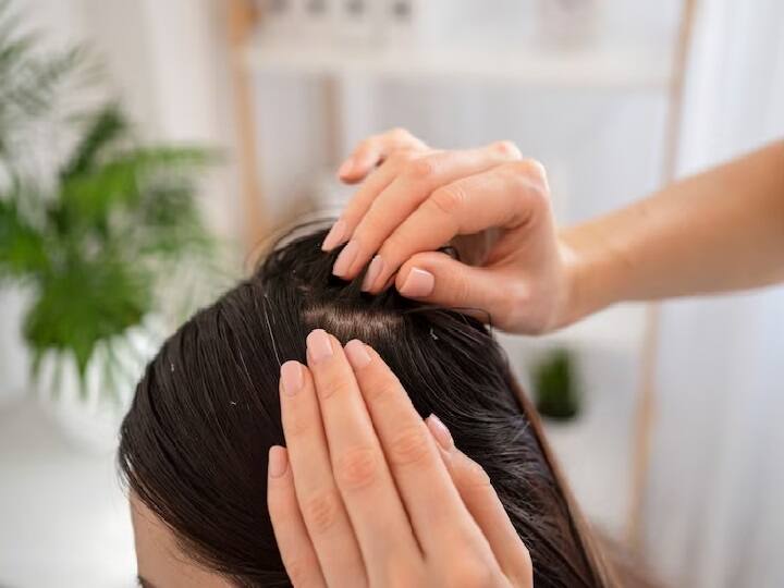 Dandruff Solution: Dandruff is not reducing from the hair… Try these hair oils today itself, dandruff will disappear
