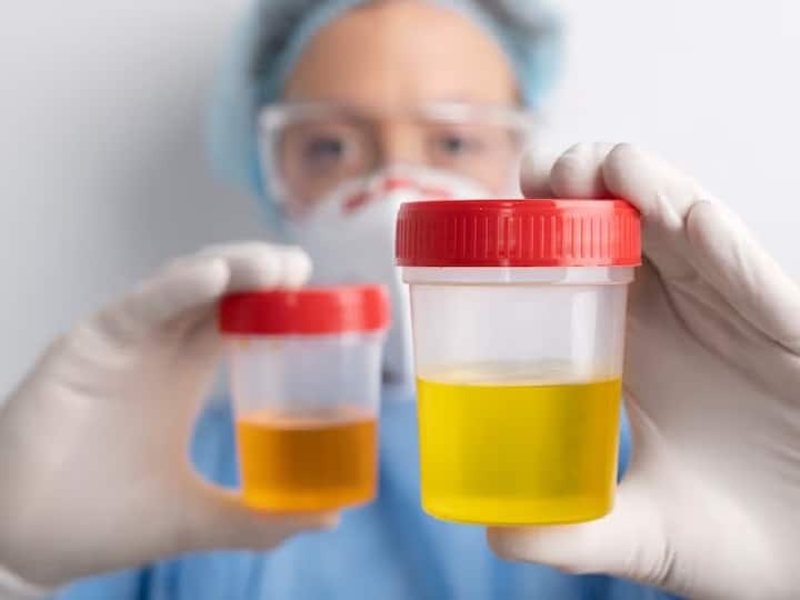 Urine Color Tells How Is Your Health Such Color Can Be A Sign Of These Diseases