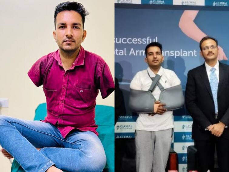 Rajasthan man becomes first Asian to undergo total arm transplant at Mumbai hospital Arm Transplant: 10 ஆண்டுகால தவிப்பு..16 மணிநேர அறுவை சிகிச்சை.. இரண்டு கைகள் பொருத்தப்பட்ட ஆசியாவின் முதல் நபர்