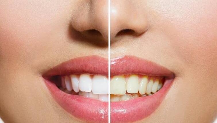Try these food items to whiten your teeth naturally! World Oral Health Day 2023: આ ફળો કુદરતી રીતે દાંતમાં જામેલી પીળાશને કરે છે સાફ, ઓરલ હેલ્થ માટે ફાયદાકારક