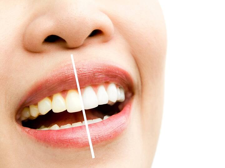 World Oral Health Day 2023 Fruits Also Remove Yellowing Of Teeth