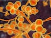 Antimicrobial-Resistant Fungus Spreading At An Alarming Rate, A Threat To ‘Very Sick’ People: CDC