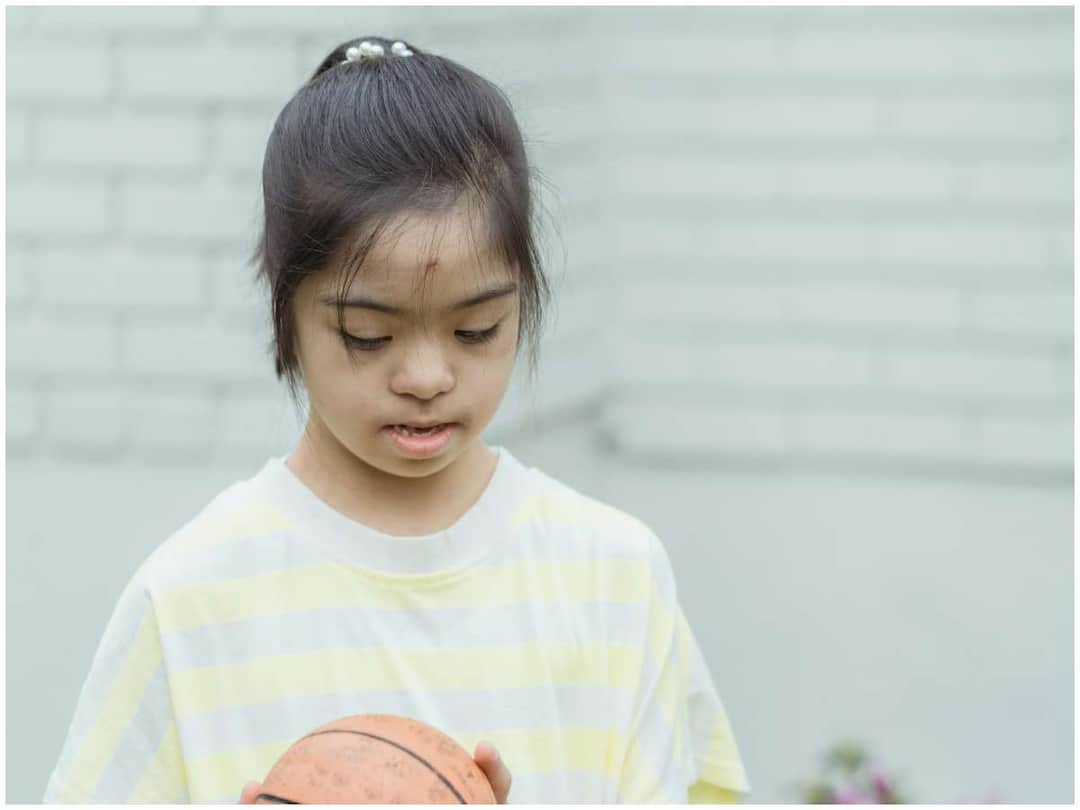 World Down Syndrome Day, Why does Down syndrome occur in children? Can we prevent it? World Down Syndrome Day: పిల్లల్లో డౌన్ సిండ్రోమ్ ఎందుకు వస్తుంది? రాకుండా ముందే అడ్డుకోగలమా?