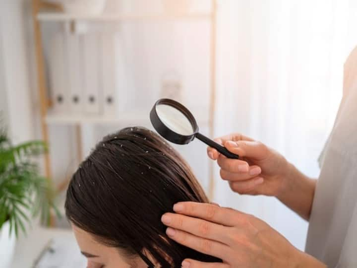 hair care tips home remedies to get dandruff free hair permanently in hindi Dandruff Treatment: बस ये 5 आसान से तरीके अपनाएं और डैंड्रफ से छुटकारा पाएं...केमिकल से बचेंगे बाल, घर में ही हो जाएगी अच्छी देखभाल