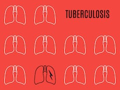 World Tuberculosis Day: In What Instances Does Latent TB Infection Become Active? Here’s What Experts Say