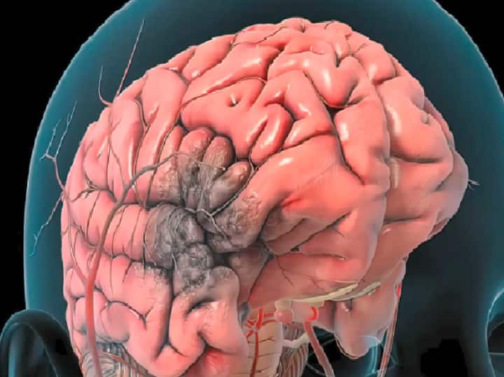 Brain Hemorrhage Causes Symptoms Treatment Recovery All Details You Need to Know Brain Hemorrhage: மூளை ரத்தக்கசிவு ஏன் ஏற்படுகிறது? அறிகுறிகள் என்ன? சிகிச்சை என்ன?