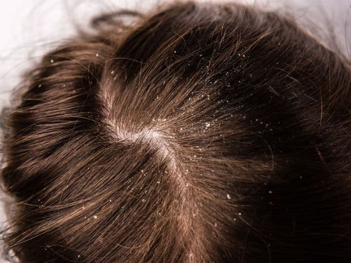 Dandruff Problem: क्या बालों में तेल लगाने से चले जातें हैं डैंड्रफ? जानिए इस बारे में क्या कहते हैं एक्सपर्ट