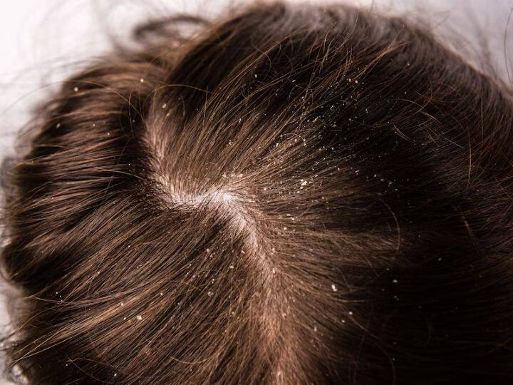 Dandruff Problem: क्या बालों में तेल लगाने से चले जातें हैं डैंड्रफ? जानिए इस बारे में क्या कहते हैं एक्सपर्ट Oiling Can Improve Dandruff Or Not How To Remove Them Easily Dandruff Problem: क्या बालों में तेल लगाने से चले जातें हैं डैंड्रफ? जानिए इस बारे में क्या कहते हैं एक्सपर्ट