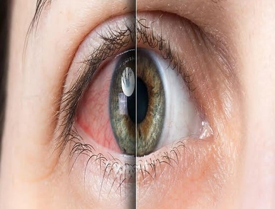 Eye Disease: these symptoms also tell that you need to get your eyes checked! Eye Disease: માત્ર ઓછું દેખાવું જ નહી.. આ લક્ષણો પણ જણાવે છે કે તમારે તમારી આંખોની તપાસ કરાવવી જરૂરી!