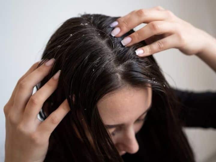 How To Get Rid Of Itchy Hair Scalp Use These 7 Home Remedy Itchy Scalp: बालों में हो रही जबरदस्त खुजली? तो तुरंत अपनाएं ये 7 घरेलू नुस्खे, झट से दूर होगी प्रॉब्लम