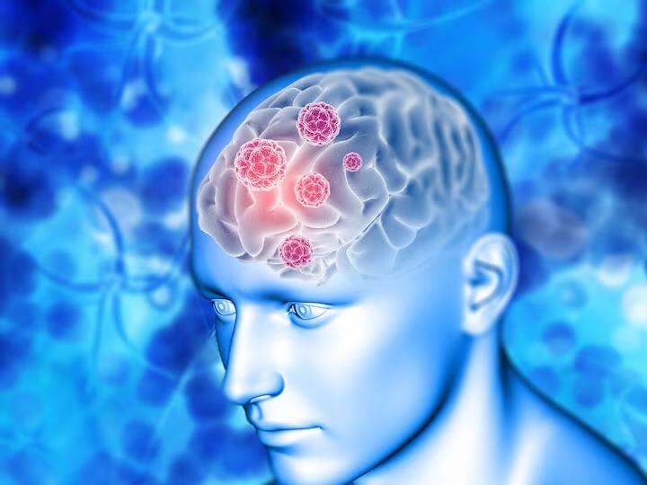 Brain Tumor Headaches Symptoms and What They Feel Like सिर के दर्द को नजरअंदाज करना पड़ सकता है भारी, हो सकती हैं ये गंभीर बीमारी