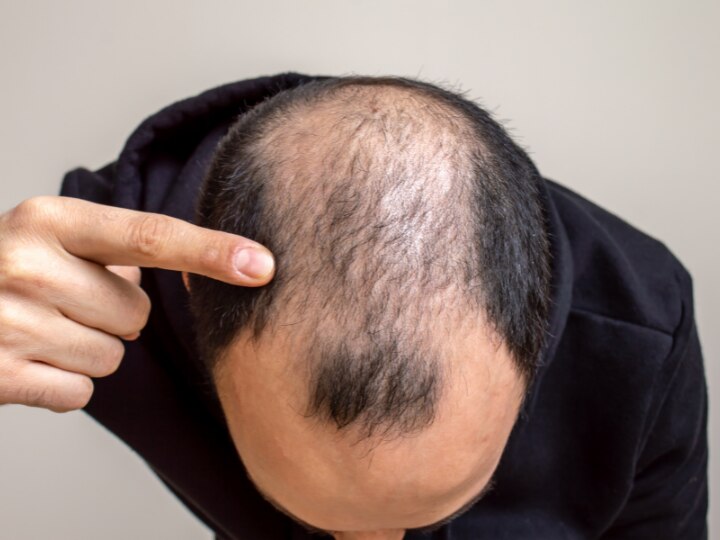 What to Know About Hair Loss From Stress  Keepscom