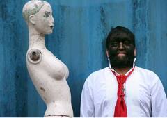 Werewolf Syndrome: ਇਹ ਕਿਦਾਂ ਦੀ ਬਿਮਾਰੀ... ਜਦੋਂ ਨੱਕ, ਕੰਨ, ਅੱਖਾਂ 'ਤੇ ਵੀ ਉੱਗ ਜਾਂਦੇ ਹਨ ਵਾਲ! ਕੁਝ ਅਜਿਹੀ ਹੁੰਦੀ ਹਾਲਤ