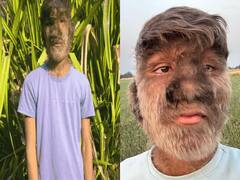 Werewolf Syndrome: ये कैसी बीमारी... जब नाक, कान, आंखों पर भी उग जाते हैं बाल! कुछ ऐसी हो जाती है हालत