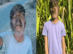 Werewolf Syndrome: ਇਹ ਕਿਦਾਂ ਦੀ ਬਿਮਾਰੀ... ਜਦੋਂ ਨੱਕ, ਕੰਨ, ਅੱਖਾਂ 'ਤੇ ਵੀ ਉੱਗ ਜਾਂਦੇ ਹਨ ਵਾਲ! ਕੁਝ ਅਜਿਹੀ ਹੁੰਦੀ ਹਾਲਤ