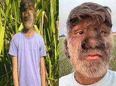 Werewolf Syndrome: ਇਹ ਕਿਦਾਂ ਦੀ ਬਿਮਾਰੀ... ਜਦੋਂ ਨੱਕ, ਕੰਨ, ਅੱਖਾਂ 'ਤੇ ਵੀ ਉੱਗ ਜਾਂਦੇ ਹਨ ਵਾਲ! ਕੁਝ ਅਜਿਹੀ ਹੁੰਦੀ ਹਾਲਤ