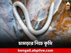 চামড়ার নিচে কিলবিল করছে পোকা! রোগীকে দেখে ভয়ে সিঁটিয়ে হাসপাতাল কর্তৃপক্ষ