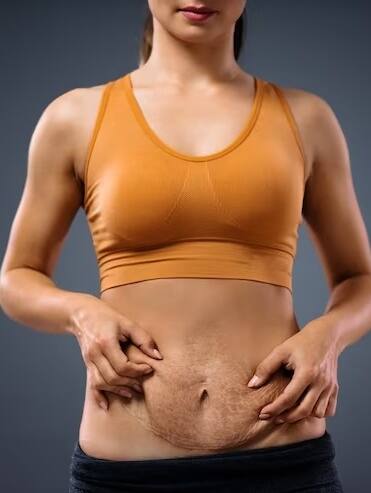 प्रेगनेंसी के स्ट्रेच मार्क्स को कम करने के ये नुस्खे हैं असरदार