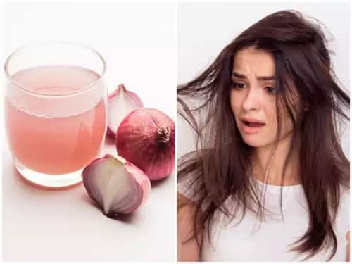 Onion Benefits: Does onion really make hair grow on bald heads? Know the logic behind it Onion Benefits: શું ખરેખર ડુંગળીના રસથી માથાની ટાલ પર ઉગે છે વાળ? જાણો તેની પાછળનું લૉજિક