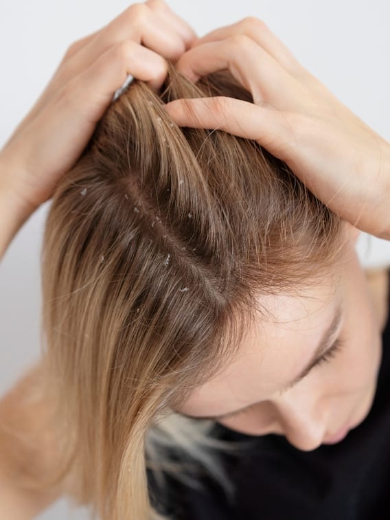 आपको भी है डैंड्रफ की समस्या? जानें इसका पर्मानेंट इलाज