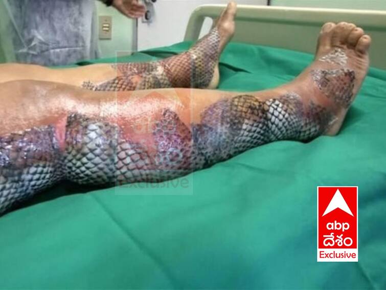 Incredible pictures burns victim turned in to  mermaid శరీరం కాలింది, చేప చర్మంలా మారింది - ఇదో వింత చికిత్స!