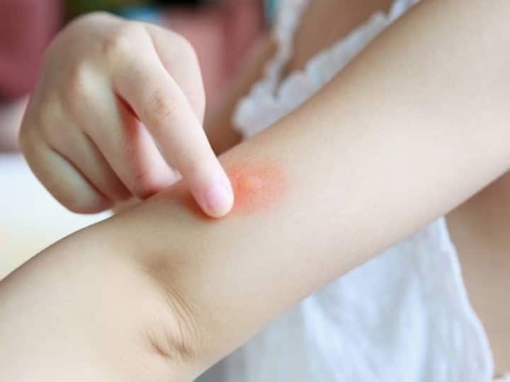 Skin care tips 5 home remedies for mosquito bite Mosquito Bite: मच्छरों के काटने से पड़ गए हैं शरीर में फफोले तो अपनाएं ये 5 तरीके, तुरंत मिलेगा आराम