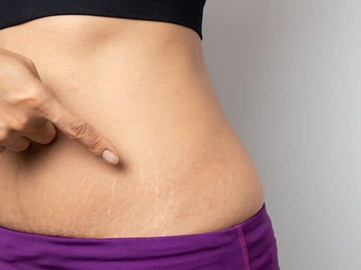 Stretch Mark Home Remedy: स्ट्रेच मार्क्स प्रेग्नेंट या बच्चे को जन्म देने वाली महिलाओं की ही समस्या नहीं है, बल्कि ये प्रॉब्लम किसी को भी शरीर के किसी भी हिस्से में हो सकती है.