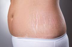 Stretch Marks: স্ট্রেচমার্কের সমস্যায় নাজেহাল? দূর করুন এইসব ঘরোয়া উপায়ের সাহায্যে