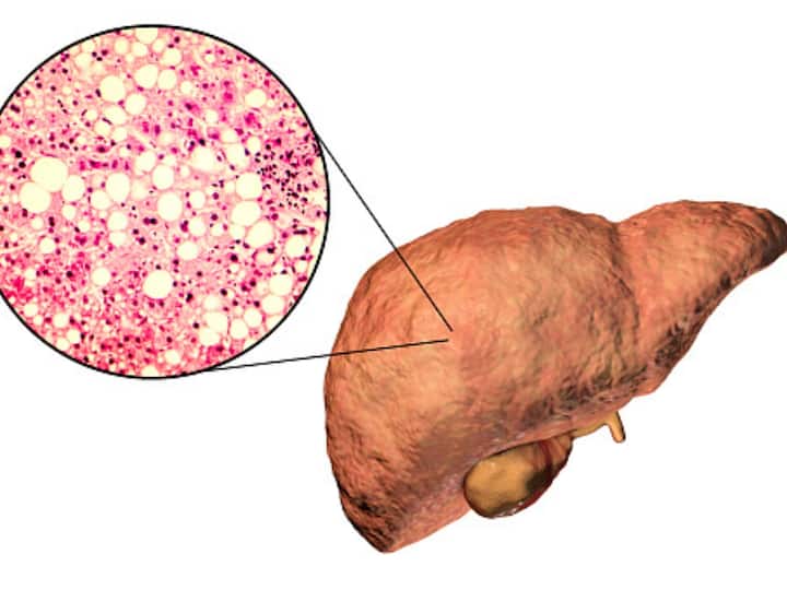 World Liver Day 2023 Cure For Fatty Liver Disease Non Alcoholic Non Steatohepatitis Know What Experts Say World Liver Day 2023: Is There Any Cure For Fatty Liver Disease? Here’s What Experts Say