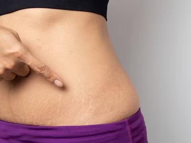 বিভিন্ন কারণে স্টেচমার্ক দেখা দিতে পারে। বিশেষ করে দৈহিক ওজনের তারতম্য ঘটলে, কোনও অস্ত্রোপচার হলে স্ট্রেচমার্ক দেখা দিতে পারে।