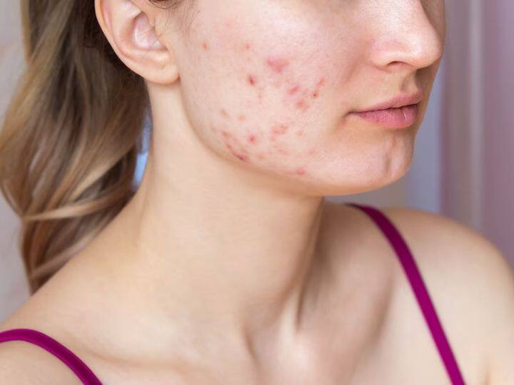 What is blind pimples?  How do they harm the face?  Learn how to fix them