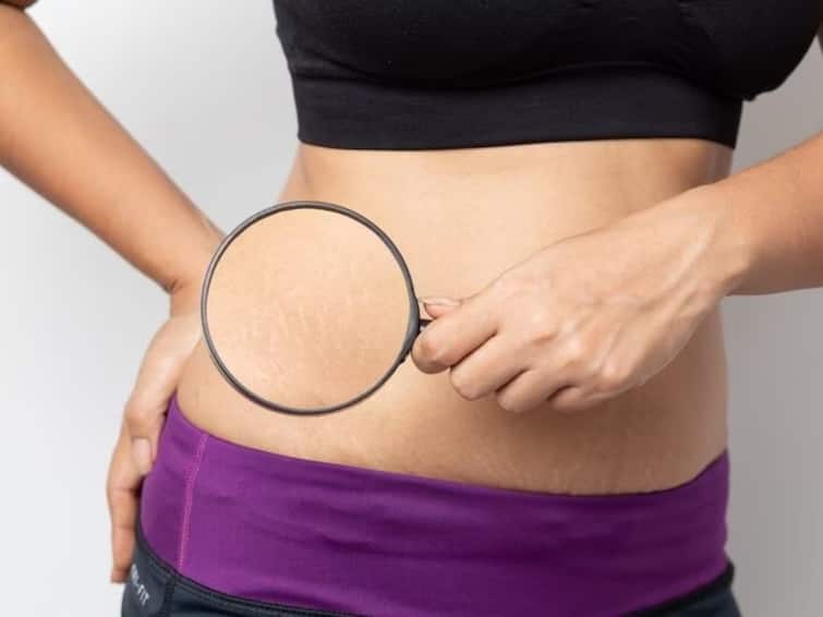easy-ways-to-prevent-stretch-marks know some essential tips Stretch Marks: কেন দেখা দেয় স্ট্রেচ মার্ক? কীভাবে দূর করবেন এই দাগ?
