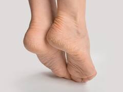 क्या गर्मियों में भी फटने लगी है आपकी एड़ियां... यहां जानिए ऐसा किस वजह से होता है?