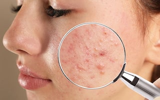 Blind Pimples: શું છે બ્લાઈન્ડ પિમ્પલ્સ? ચહેરાને કેવી રીતે પહોંચાડે છે નુકસાન? જાણો તેને ઠીક કરવાના ઉપાયો
