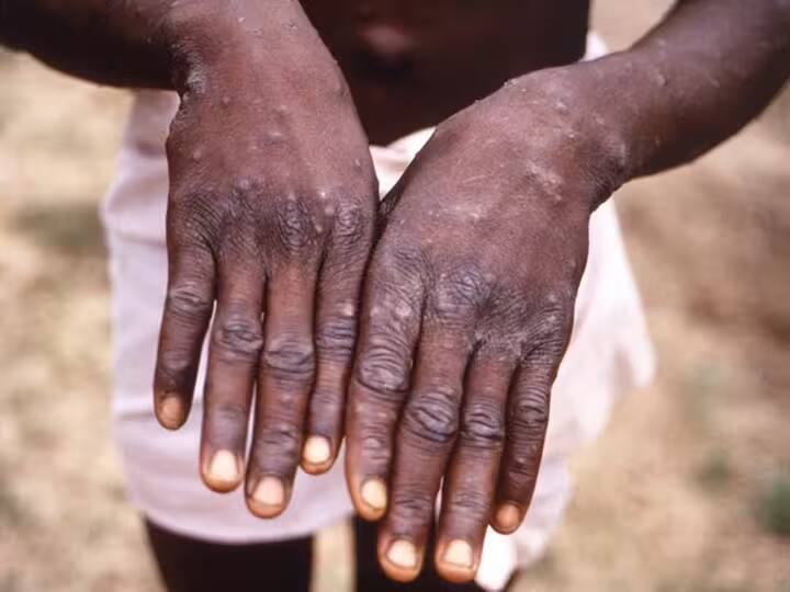 Pakistan Monkeypox: अफ्रीका के बाद अब पाकिस्तान पहुंचा मंकी वायरस, भारत को इससे कितना खतरा? Pakistan Health ministry officials informed about first case of monkeypox Pakistan Monkeypox: अफ्रीका के बाद अब पाकिस्तान पहुंचा मंकी वायरस, भारत को इससे कितना खतरा?