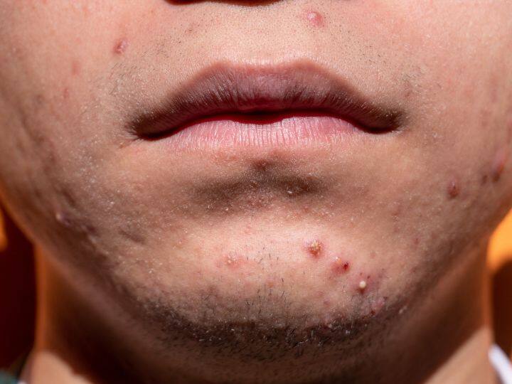 how your mobile may cause of pimple acne and breakouts skin care tips in hindi आपके फोन से हो रहे हैं मुंह पर एक्ने... जानिए आखिर ऐसा कैसे हो सकता है?