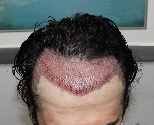 Can Laser Hair Removal Cause Cancer skincaretips laser Dr Deepak P  Devakar  Doctors Circle  YouTube