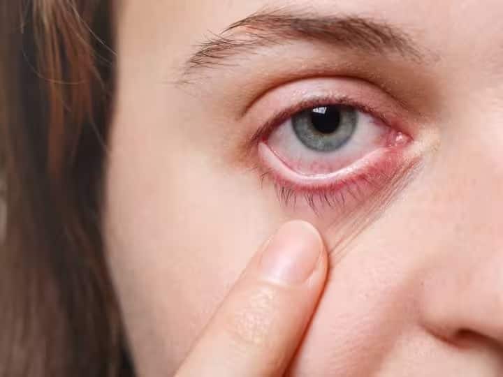 red eye causes and how to treat eye redness marathi news Health Tips : तुमचे डोळे वारंवार लाल होतात? ही सामान्य समस्या नाही तर आहे गंभीर आजार; वेळीच सावध व्हा