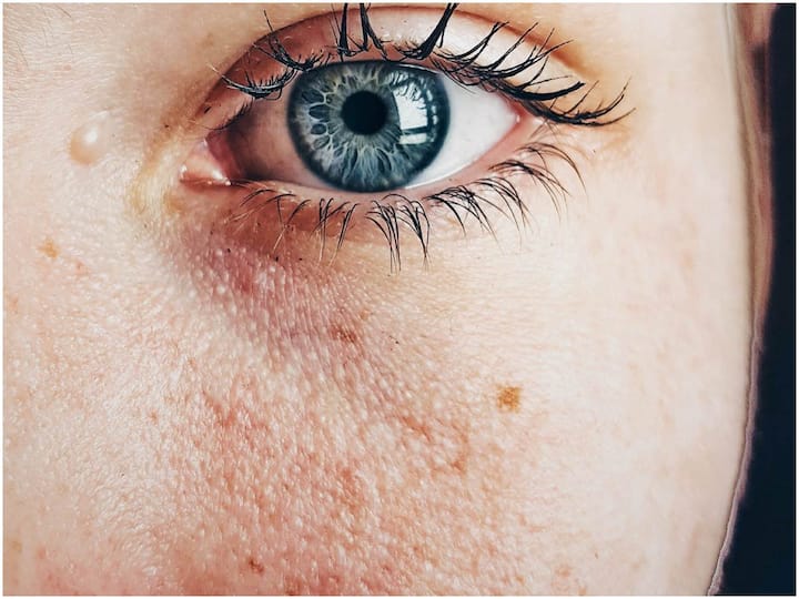 Doctors Discover Worlds Smallest Skin Cancer Under Woman Eye World Smallest Skin Cancer: మహిళ కంటి కింద అతి చిన్న చర్మ క్యాన్సర్- గిన్నిస్ వరల్డ్ రికార్డ్ సృష్టించిన వైద్యులు