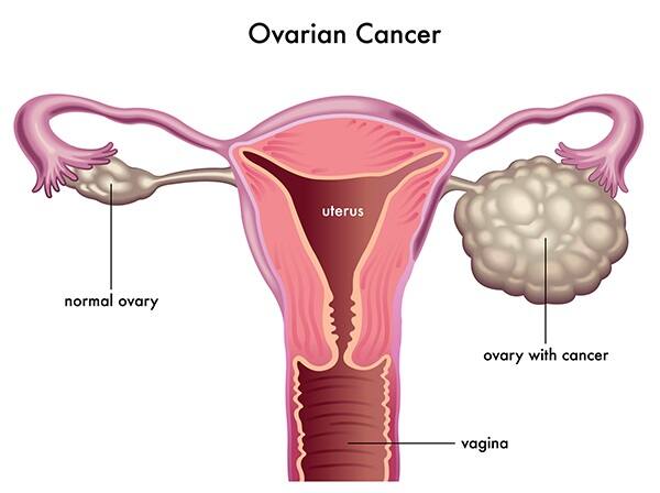 Ovarian Cancer: If these 7 symptoms are ignored then 'ovarian cancer' can reach the last stage varian Cancer: જો આ 7 લક્ષણોને કરશો નજરઅંદાજ, તો છેલ્લા સ્ટેજ પર પહોંચી શકે છે 'Ovarian Cancer'