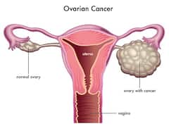 varian Cancer: જો આ 7 લક્ષણોને કરશો નજરઅંદાજ, તો છેલ્લા સ્ટેજ પર પહોંચી શકે છે 'Ovarian Cancer'