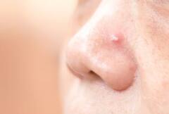 ਜੇਕਰ ਤੁਹਾਡੇ ਨੱਕ 'ਤੇ ਹੋ ਰਿਹਾ ਪਿੰਪਲ, ਤਾਂ ਭੁੱਲ ਕੇ ਵੀ ਨਾ ਕਰੋ ਨਜ਼ਰਅੰਦਾਜ਼, ਹੋ ਸਕਦੀ ਇਹ ਖਤਰਨਾਕ ਬਿਮਾਰੀ