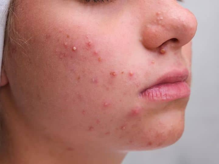 Basal Cell Carcinoma Woman Have Painful Pimple On Nose Diagnosed With Skin Cancer नाक पर हुई फुंसी को पिंपल समझती रही महिला, जांच हुई तो पता चला कि 'जानलेवा कैंसर' है
