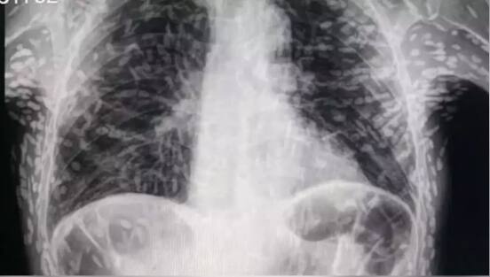 man went to doctor for treatment of cough so many worms seen in xray got goosebumps ਖਾਂਘ ਦੇ ਇਲਾਜ ਲਈ ਡਾਕਟਰ ਕੋਲ ਗਿਆ ਵਿਅਕਤੀ, ਹੋਇਆ ਹੈਰਾਨ ਕਰ ਦੇਣ ਵਾਲਾ ਖੁਲਾਸਾ,  ਐਕਸਰੇ 'ਚ ਨਜ਼ਰ ਆਏ ਕਈ ਕੀੜੇ