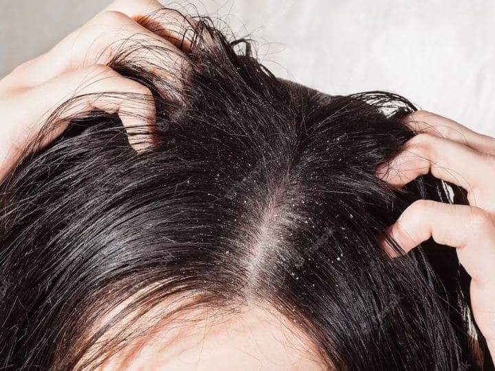 Anti Dandruff Shampoo Side Effects Know Why This Shampoo Is Not Good For Your Hair पॉपुलर हेयर स्टाइलिस्ट ने 'एंटी-डैंड्रफ शैंपू' को बताया बालों के लिए खतरनाक, जानें उन्होंने ऐसा क्यों कहा?