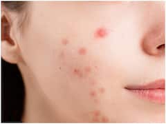 Cancer: యువతికి చిన్న మొటిమ వచ్చింది, తర్వాత ప్రాణాంతక క్యాన్సర్‌గా మారింది