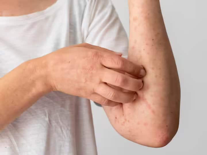 Scabies is a very dangerous disease know its symptoms and treatment त्वचा की बहुत ही खतरनाक बीमारी है स्कैबीज...एक बार हो जाए तो होने लगती है ये समस्या