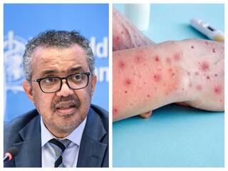 MPOX Disease : நிம்மதி... முடிவுக்கு வந்த குரங்கு அம்மை நோய் அவசர நிலை... உலக சுகாதார அமைப்பு அறிவிப்பு...!